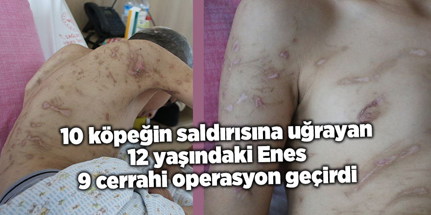 10 köpeğin saldırısına uğrayan 12 yaşındaki Enes 9 cerrahi operasyon geçirdi