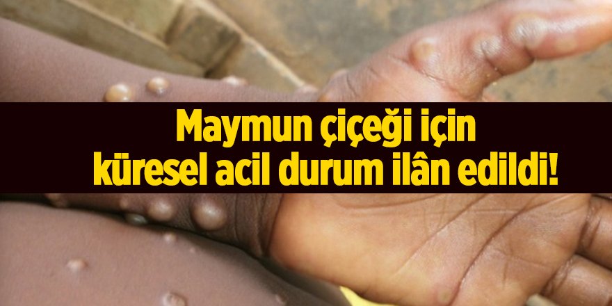 Maymun çiçeği için küresel acil durum ilân edildi!