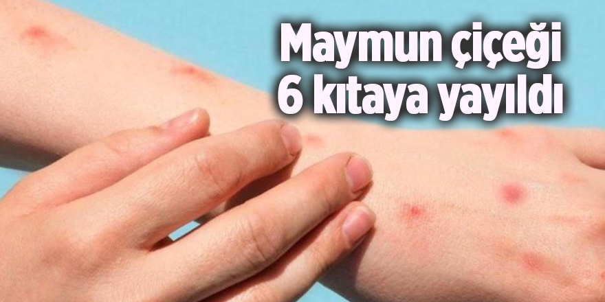 Maymun çiçeği 6 kıtaya yayıldı